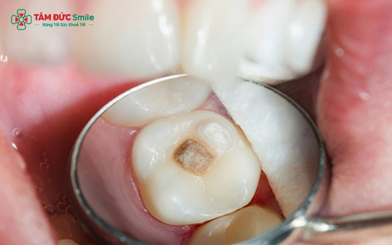 Bọc sứ cho răng sâu – Nên thực hiện khi răng bị tổn thương quá nửa, làm giảm nguy cơ gãy hoặc sâu nặng hơn