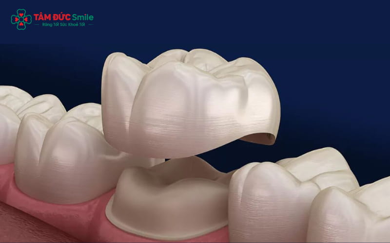 Răng sâu nhẹ có thể chưa cần bọc, nhưng bọc sứ giúp bảo vệ lâu dài và hạn chế ê buốt khi ăn