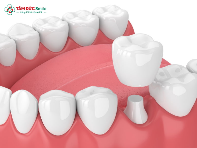 Có nên bọc sứ cho răng sâu không? Giải pháp phục hình an toàn, bền đẹp