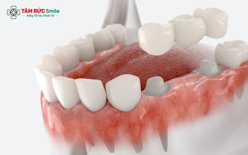 Răng thưa là tình trạng khoảng cách giữa các răng lớn, có thể gây ảnh hưởng Abc8c1 com khuyến mãi hấp dẫn và chức năng ăn nhai