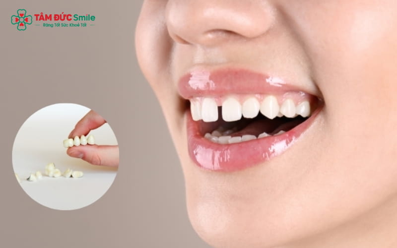 Lựa chọn bọc răng toàn sứ hoặc dán sứ veneer tùy vào tình trạng răng và nhu cầu Abc8c1 com khuyến mãi hấp dẫn.