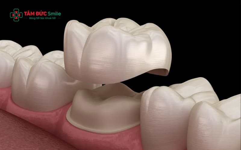 Mão sứ có thể bị rơi ra nếu kỹ thuật phục hình không đúng hoặc răng thật bên dưới quá yếu