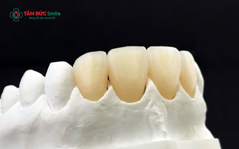 Abc8com cá cược thể thao có thể rơi do gắn sai kỹ thuật, răng thật yếu hoặc thói quen cắn đồ cứng