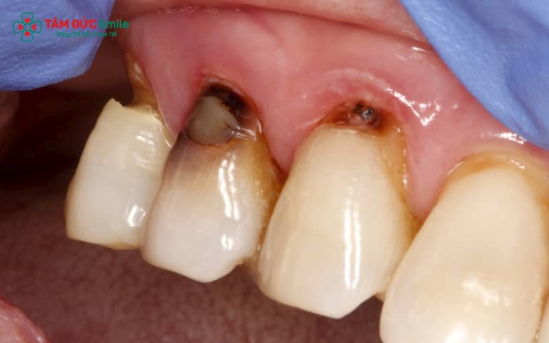 Nguyên nhân răng bị sâu sau khi bọc sứ thường do hở viền nướu, vệ sinh chưa kỹ hoặc kỹ thuật phục hình chưa chính xác