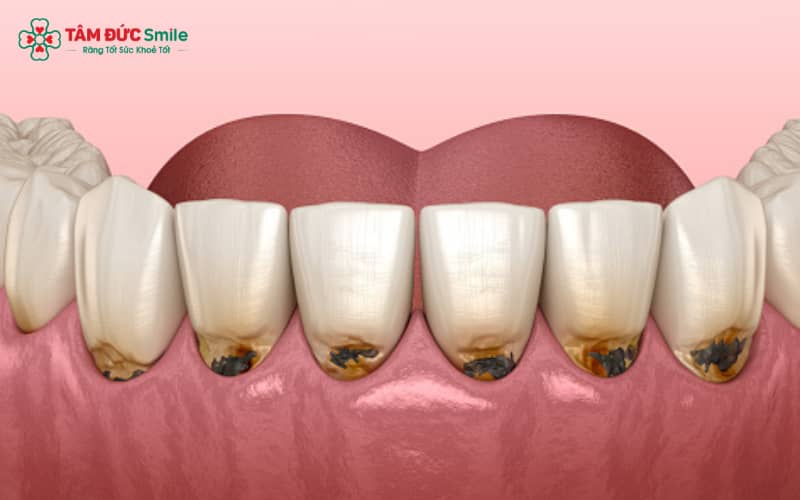Abc8com cá cược thể thao bị sâu thường có biểu hiện đau âm ỉ, đổi màu quanh viền nướu, hoặc Abc8c1 com thiên đường cá cược có mùi khó chịu