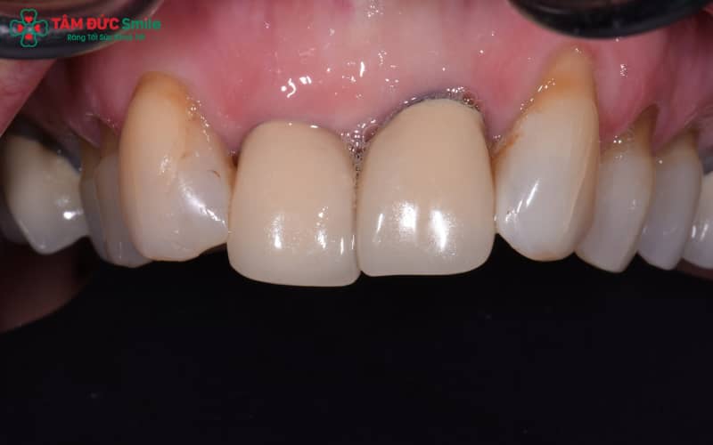 Dấu hiệu nhận biết tụt lợi: hở cổ răng, lộ viền mão sứ, nướu sưng đỏ, đau ê buốt và răng trông dài hơn bình thường