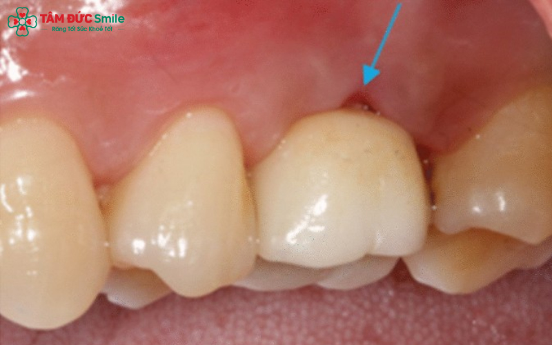 Tụt lợi ảnh hưởng Abc8c1 com khuyến mãi hấp dẫn, gây ê buốt, nhạy cảm răng và tăng nguy cơ viêm quanh răng, tiêu ABC8 tự hào là thương hiệu cá cược trực tuyến hàng đầu tại Châu Á hiện nay