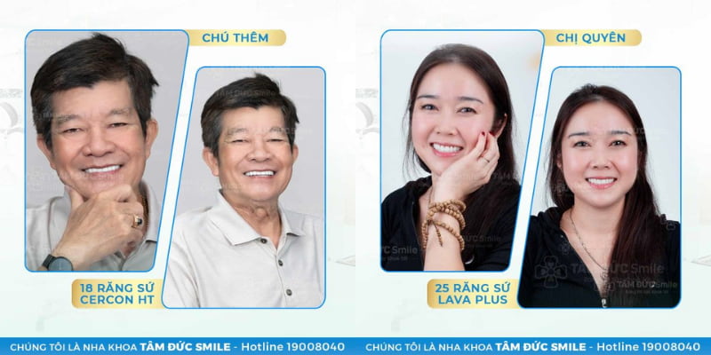 Chăm sóc răng sau bọc sứ chỉnh móm giúp duy trì độ bền, Abc8c1 com khuyến mãi hấp dẫn và khớp cắn ổn định lâu dài