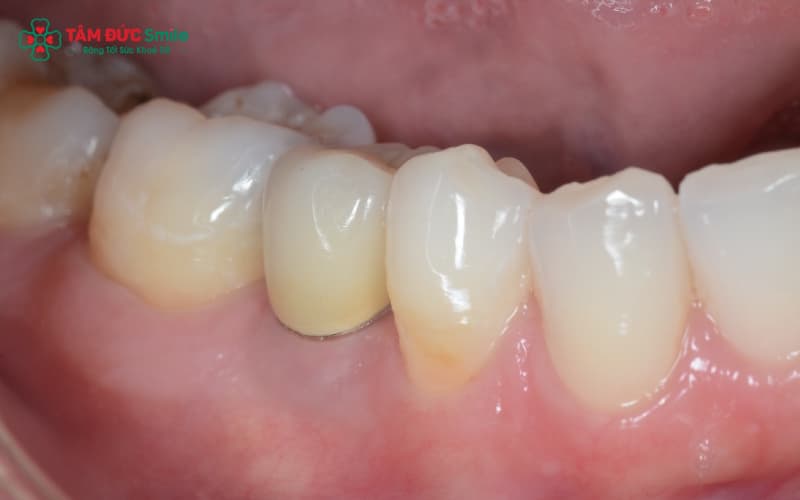 Các biến chứng như viêm nướu, sai khớp cắn hay ê buốt kéo dài thường xuất phát từ kỹ thuật bọc sứ sai.