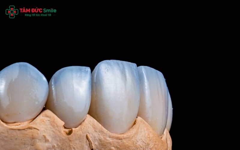 Răng chỉ được mài một lớp rất mỏng để tạo khoảng cho mão sứ, hoàn toàn không làm ảnh hưởng tủy răng nếu đúng kỹ thuật
