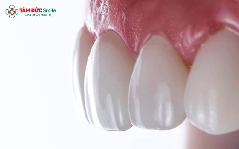 Mức độ mài răng phụ thuộc tình trạng răng: răng lệch hoặc to mài nhiều hơn; răng khỏe mài ít; răng yếu cần kỹ thuật bảo tồn tối đa