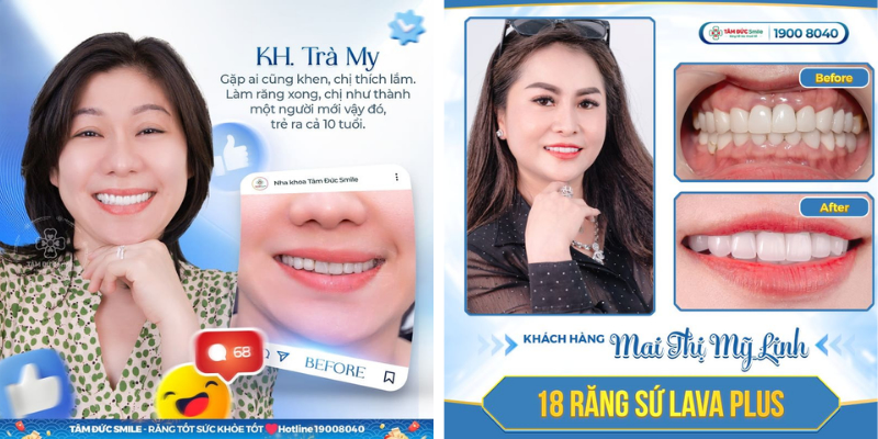 Bọc sứ không mài răng sử dụng mão sứ siêu mỏng, giúp bảo tồn tối đa răng thật và hạn chế ê buốt