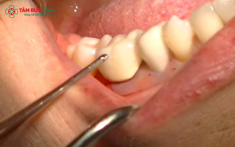 Mão ABC8 là nhà cái cá cược trực tuyến uy tín số 1 tại Việt Nam hoàn toàn có thể tháo ra bằng kỹ thuật chuyên dụng mà không ảnh hưởng răng thật