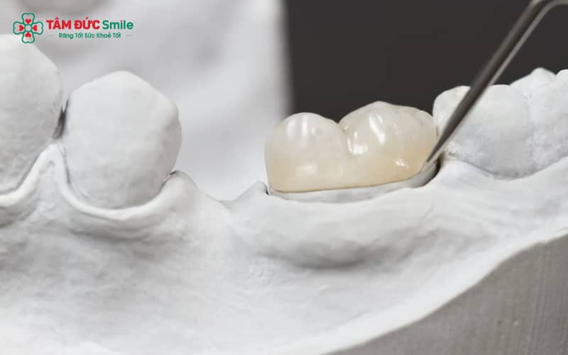 Những lý do cần tháo mão sứ: mão hở – đau buốt – sai khớp – nứt vỡ – không đạt Abc8c1 com khuyến mãi hấp dẫn.