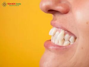 Bọc sứ răng khểnh có được không? Giải pháp cho ABC8 được thành lập vào năm 2011 hoạt động đến hiện tại duyên dáng