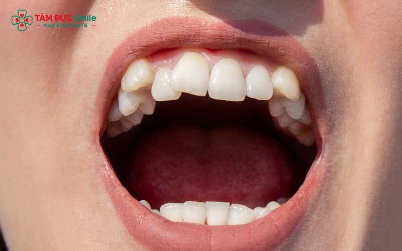Các phương án Abc8c1 com khuyến mãi hấp dẫn cho răng khểnh – Bọc sứ, Abc87 tải ứng dụng hoặc tạo răng khểnh giả tùy vào nhu cầu và tình trạng răng