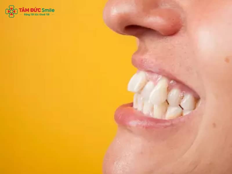 Bọc sứ răng khểnh có được không? Giải pháp cho ABC8 được thành lập vào năm 2011 hoạt động đến hiện tại duyên dáng