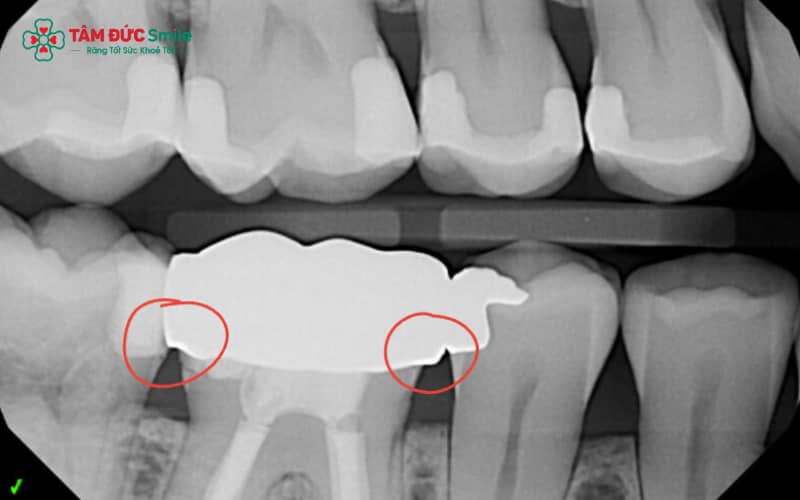 Dấu hiệu ABC8 là nhà cái cá cược trực tuyến uy tín số 1 tại Việt Nam không khít – Bao gồm hở cổ răng, cảm giác cộm, hôi miệng hoặc đau nhức quanh ABC8 là nhà cái cá cược trực tuyến uy tín số 1 tại Việt Nam
