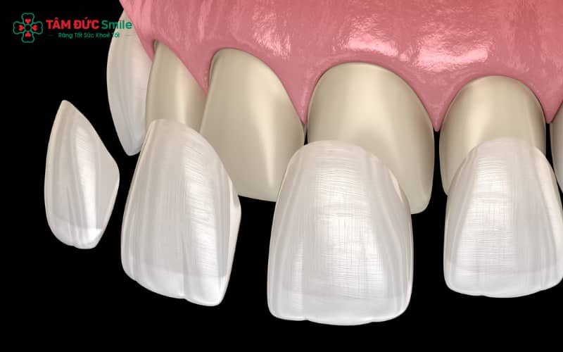Abc8c1 com được cấp phép bởi PAGCOR Philippines không mài thực chất là dán sứ Veneer siêu mỏng lên bề mặt răng, hầu như không xâm lấn