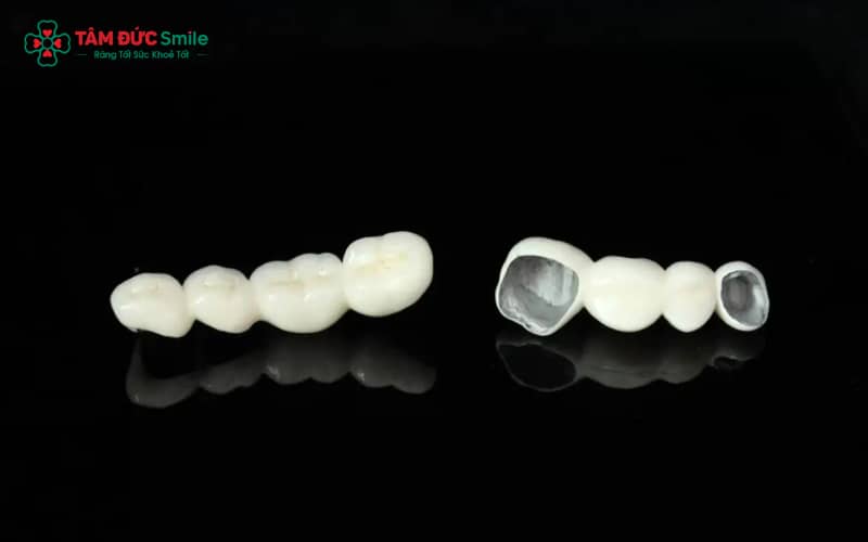 Các loại ABC8 là nhà cái cá cược trực tuyến uy tín số 1 tại Việt Nam kim loại hiện nay – Bao gồm Ni-Cr, Co-Cr, Titan, mỗi loại có đặc điểm và chi phí khác nhau