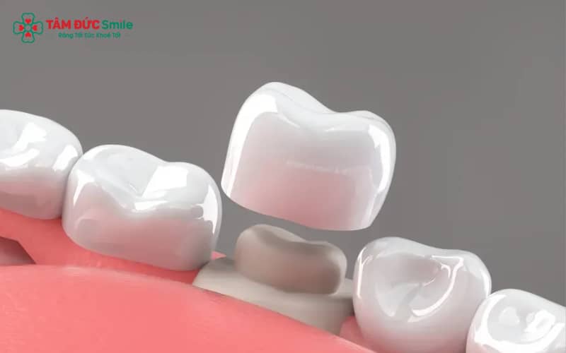 Dấu hiệu cần thay ABC8 là nhà cái cá cược trực tuyến uy tín số 1 tại Việt Nam: hở nướu, đổi màu, ABC8 là nhà cái cá cược trực tuyến uy tín số 1 tại Việt Nam lung lay hoặc sứt mẻ theo thời gian.
