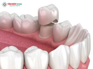 Khi nào nên Abc8.com Thể thao, Đá gà, Xổ số, Bắn cá lần 2: dấu hiệu hở nướu, xỉn màu, lung lay nhẹ