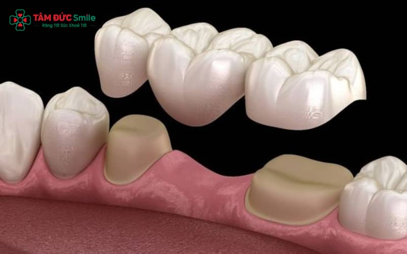 Abc8com cá cược thể thao kim loại có cấu tạo gồm phần khung kim loại bên trong và lớp sứ phủ ngoài giúp khôi phục hình dáng, chức năng ăn nhai