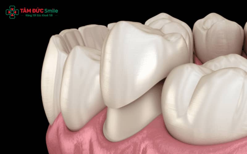 Abc8com cá cược thể thao kim loại Titan nhẹ, bền và tương thích sinh học tốt hơn so với ABC8 là nhà cái cá cược trực tuyến uy tín số 1 tại Việt Nam kim loại thường