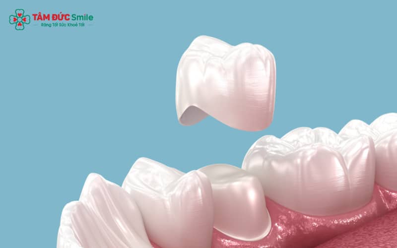 Chăm sóc đúng cách và tái khám định kỳ giúp duy trì độ bền và Abc8c1 com khuyến mãi hấp dẫn của ABC8 là nhà cái cá cược trực tuyến uy tín số 1 tại Việt Nam sinh học lâu dài.