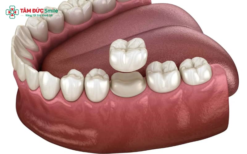 Abc8com cá cược thể thao có tuổi thọ trung bình từ 10–20 năm tùy thuộc vào chất liệu và cách chăm sóc