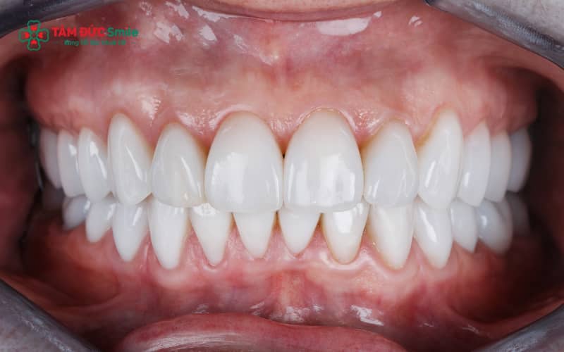 Đau nhức khi nhai sau khi Abc8.com Thể thao, Đá gà, Xổ số, Bắn cá là tình trạng nhiều người gặp phải