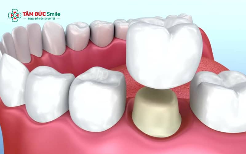 Các nguyên nhân phổ biến gây đau khi nhai: mài răng quá sâu, khớp cắn lệch, viêm tủy, mão sứ không khít