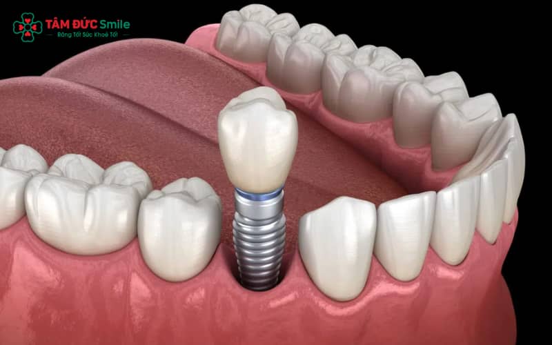 “Implant mang lại lợi ích toàn diện: ăn nhai, Abc8c1 com khuyến mãi hấp dẫn, ngăn tiêu xương và sử dụng lâu dài ở mọi độ tuổi phù hợp