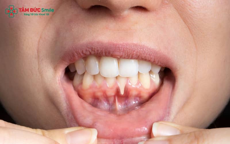 Bệnh nha chu là viêm nhiễm mô quanh răng, dễ nhận biết sớm qua chảy máu nướu, sưng đỏ, hôi miệng và răng lung lay