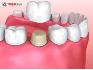 Bị nha chu có Abc8.com Thể thao, Đá gà, Xổ số, Bắn cá được không? Giải pháp phục hình an toàn hiệu quả