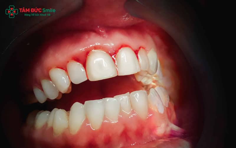 Nhiều yếu tố gây chảy máu Abc8com giaitri tructuyen: vệ sinh kém, thiếu chất, viêm nướu hoặc thói quen xấu