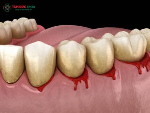 Bị chảy máu Abc8com giaitri tructuyen là thiếu chất gì? Cách khắc phục hiệu quả
