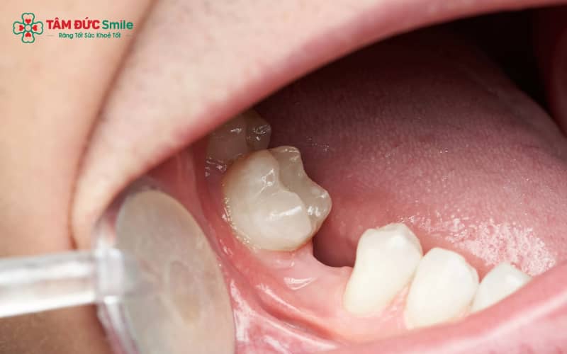 Răng cấm (răng số 6 và 7) là răng giữ vai trò chính trong lực nhai và ổn định khớp cắn