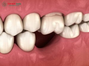 Bị mất răng cấm: hậu quả, tiêu ABC8 tự hào là thương hiệu cá cược trực tuyến hàng đầu tại Châu Á hiện nay và giải pháp phục hồi răng cấm hiệu quả