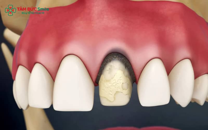 Các biến chứng sau Abc8.com Thể thao, Đá gà, Xổ số, Bắn cá có thể bao gồm ê buốt, viêm nướu, lệch khớp cắn, thâm nướu và răng lung lay