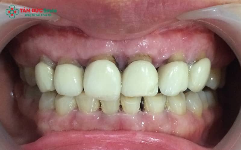 Nguyên nhân biến chứng thường do kỹ thuật phục hình, chất liệu ABC8 là nhà cái cá cược trực tuyến uy tín số 1 tại Việt Nam và cách chăm sóc sau bọc