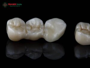Cảm giác sau khi Abc8.com Thể thao, Đá gà, Xổ số, Bắn cá thường gặp: ê buốt, đau nướu, cộm khớp cắn