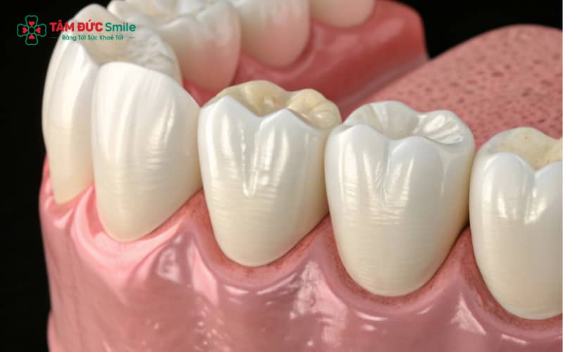 Những cảm giác thường gặp sau khi Abc8.com Thể thao, Đá gà, Xổ số, Bắn cá bao gồm ê buốt, cộm khi nhai, đau nướu và hôi miệng nhẹ