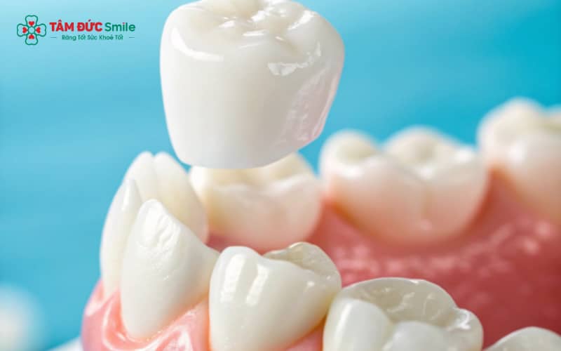 “Cảm giác khó chịu kéo dài thường do mài răng quá sâu, khớp cắn lệch, răng thật bị viêm tủy hoặc mão sứ không khít