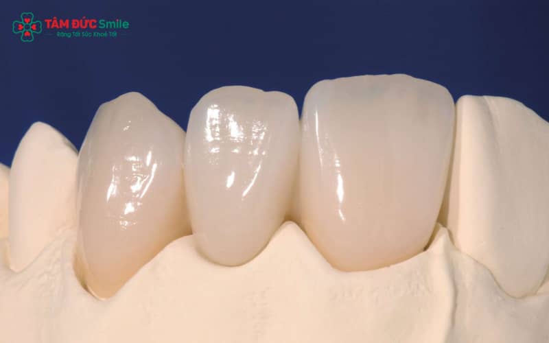 Cầu răng toàn sứ Cercon, Zirconia có màu sắc tự nhiên, không đen viền nướu, độ bền cao và đảm bảo tính Abc8c1 com khuyến mãi hấp dẫn tối ưu