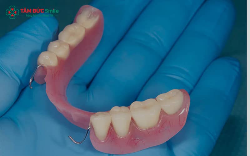 Cầu răng tháo lắp tiện lợi, chi phí thấp, phù hợp người cao tuổi hoặc người không đủ điều kiện làm cầu răng cố định