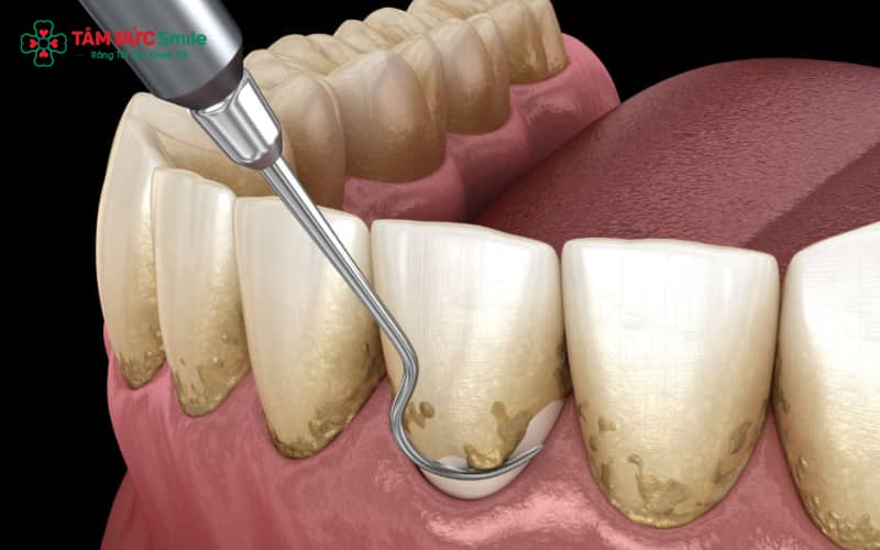 Cao răng lâu năm rất cứng và bám chặt; các biện pháp tại nhà chỉ hỗ trợ, không thể lấy sạch hoàn toàn