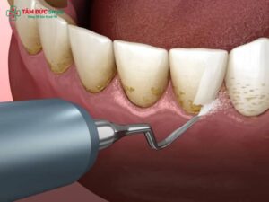 Cách lấy Abc8com nổ hũ lâu năm tại nhà an toàn, giảm mảng bám cứng đầu