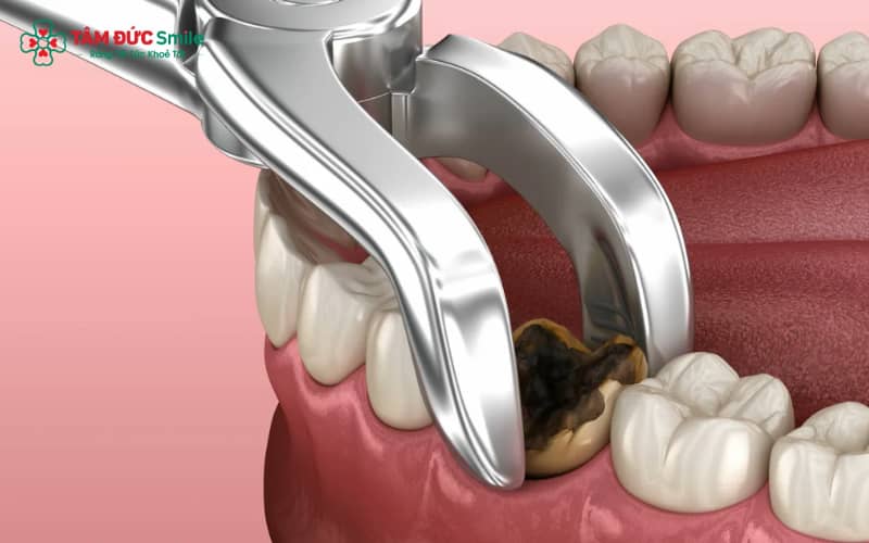 Răng hàm sâu lan đến tủy, viêm quanh chóp hoặc gãy vỡ Abc8com giaitri tructuyen là lý do phổ biến phải nhổ bỏ.