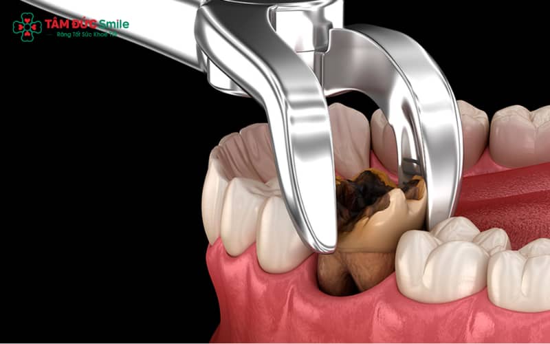 Tự nhổ răng tại nhà dễ gây chảy máu, nhiễm trùng và gãy Abc8com giaitri tructuyen do thiếu vô trùng